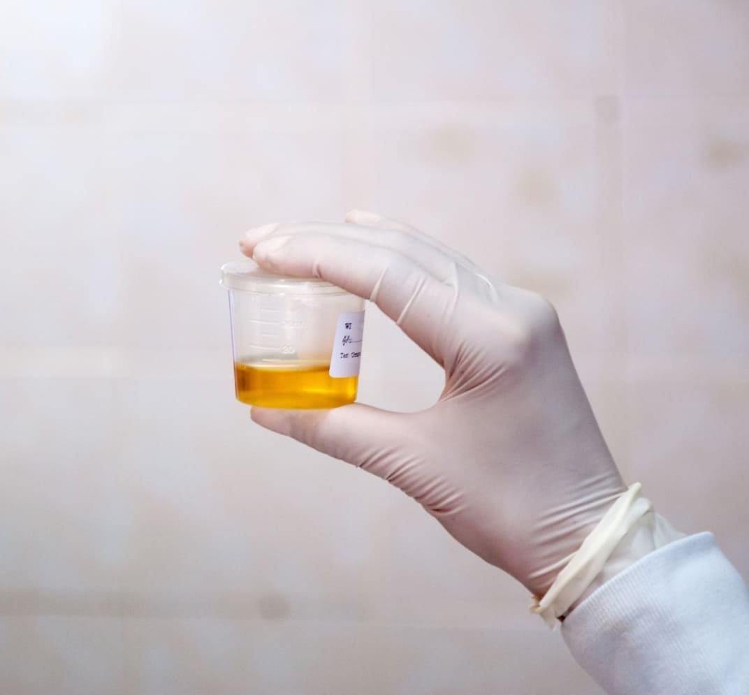 Candidose le test urinaire
