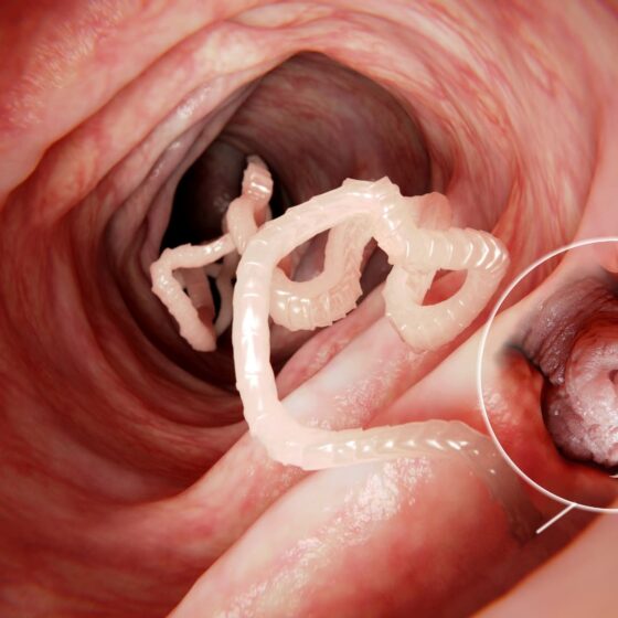 Parasites intestinaux maladies