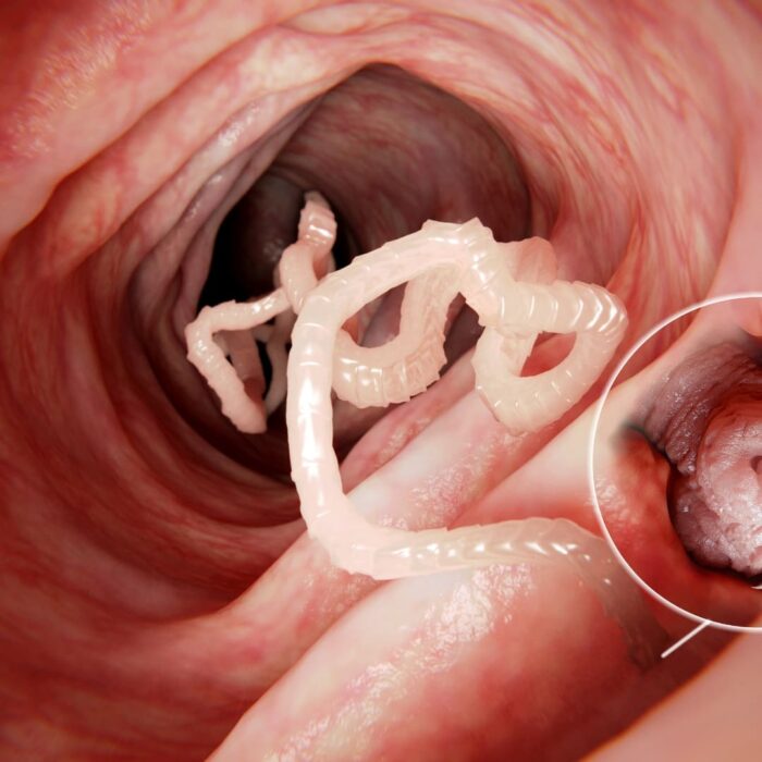 Parasites intestinaux maladies